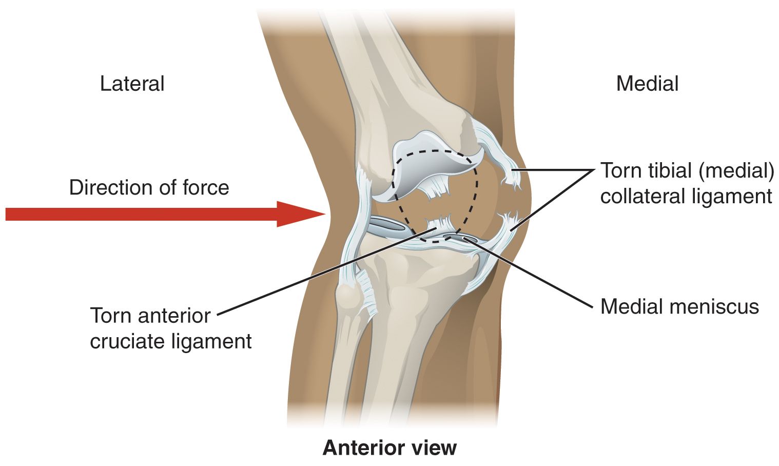 reasons-behind-acl-anterior-cruciate-ligament-injury-blurbgeek