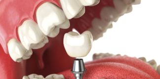 Seniors: Here’s How Dental Implants Can Restore Your Smile